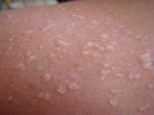 How To Treat Sun Blisters Tips And Advice