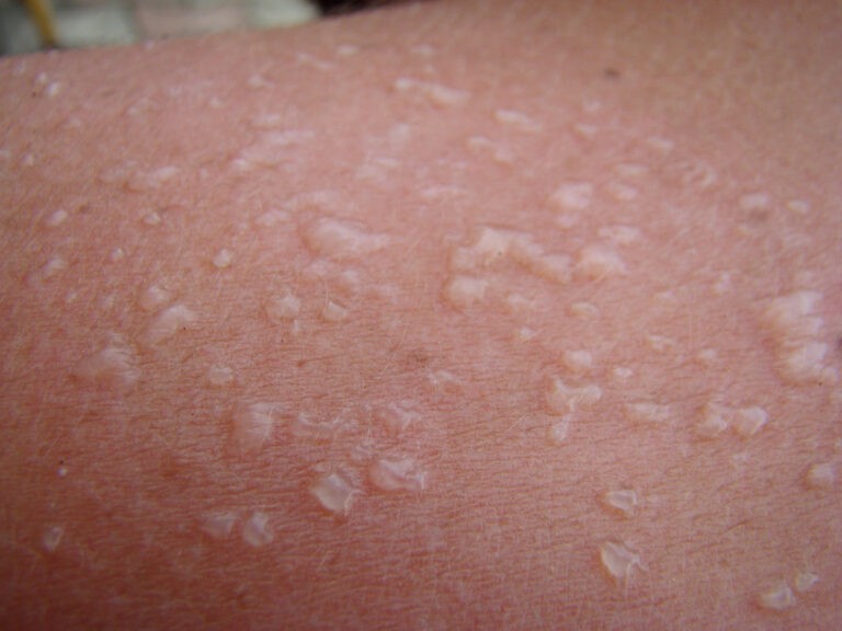 how-to-treat-sun-blisters-tips-and-advice-tgh-urgent-care