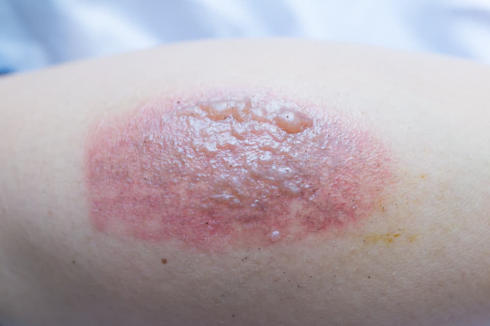 Handling Burn Blisters Best Practices And Precautions To Avoid Burns In The Kitchen This Holiday Season