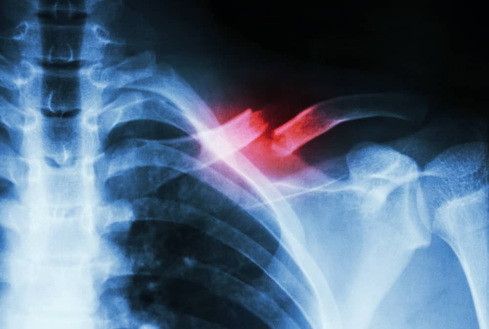 Shedding Light On Bone Health The Essential Role Of X Rays In Fracture Detection And Management