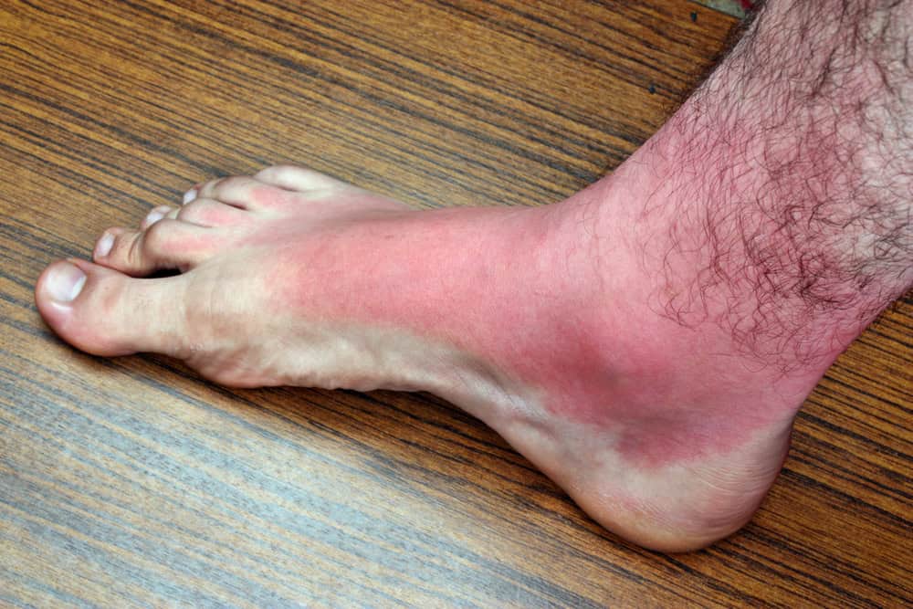 Beach Day Mishaps First Aid For Common Cuts Scrapes Sunburns And Stings