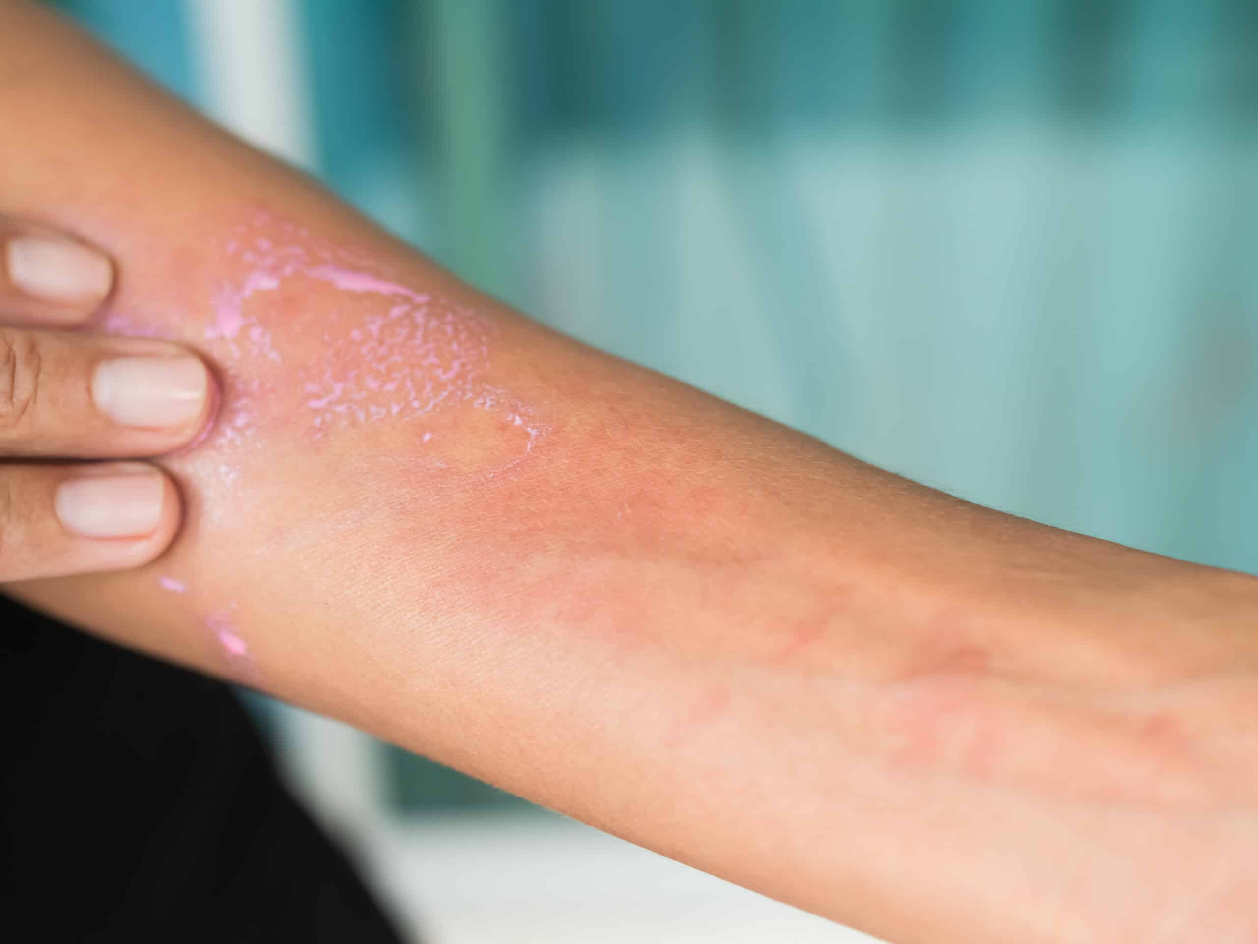 Eczema