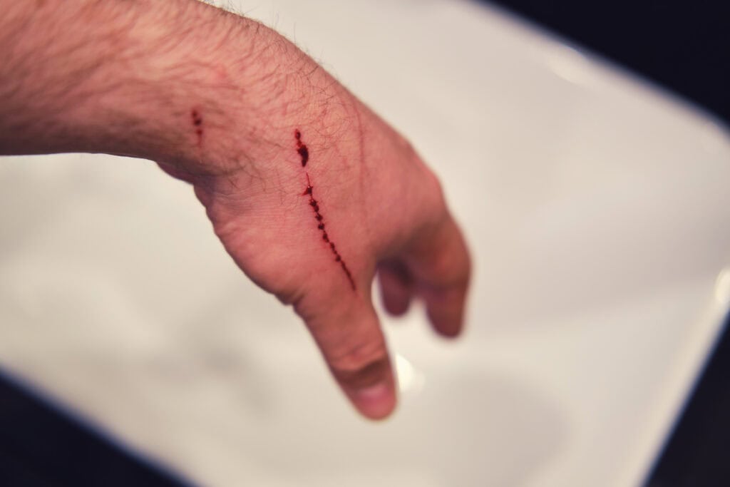 Cut Yourself Cleaning Up After the Storm? Come In Today