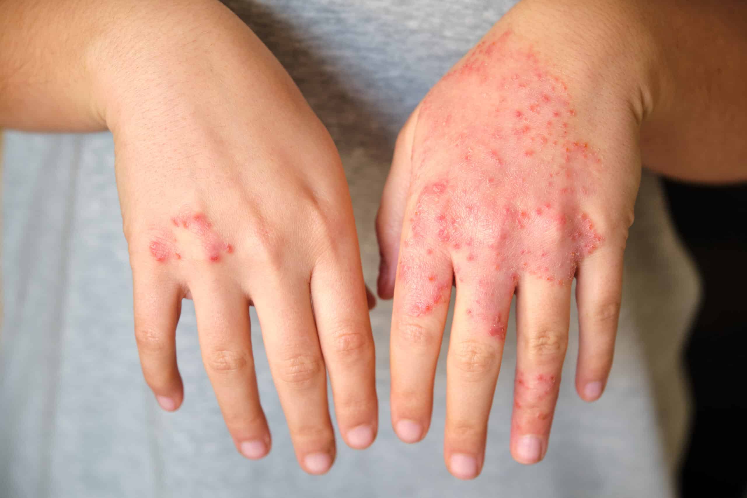 Skin Rashes: Allergies, Infections, or Something Else?