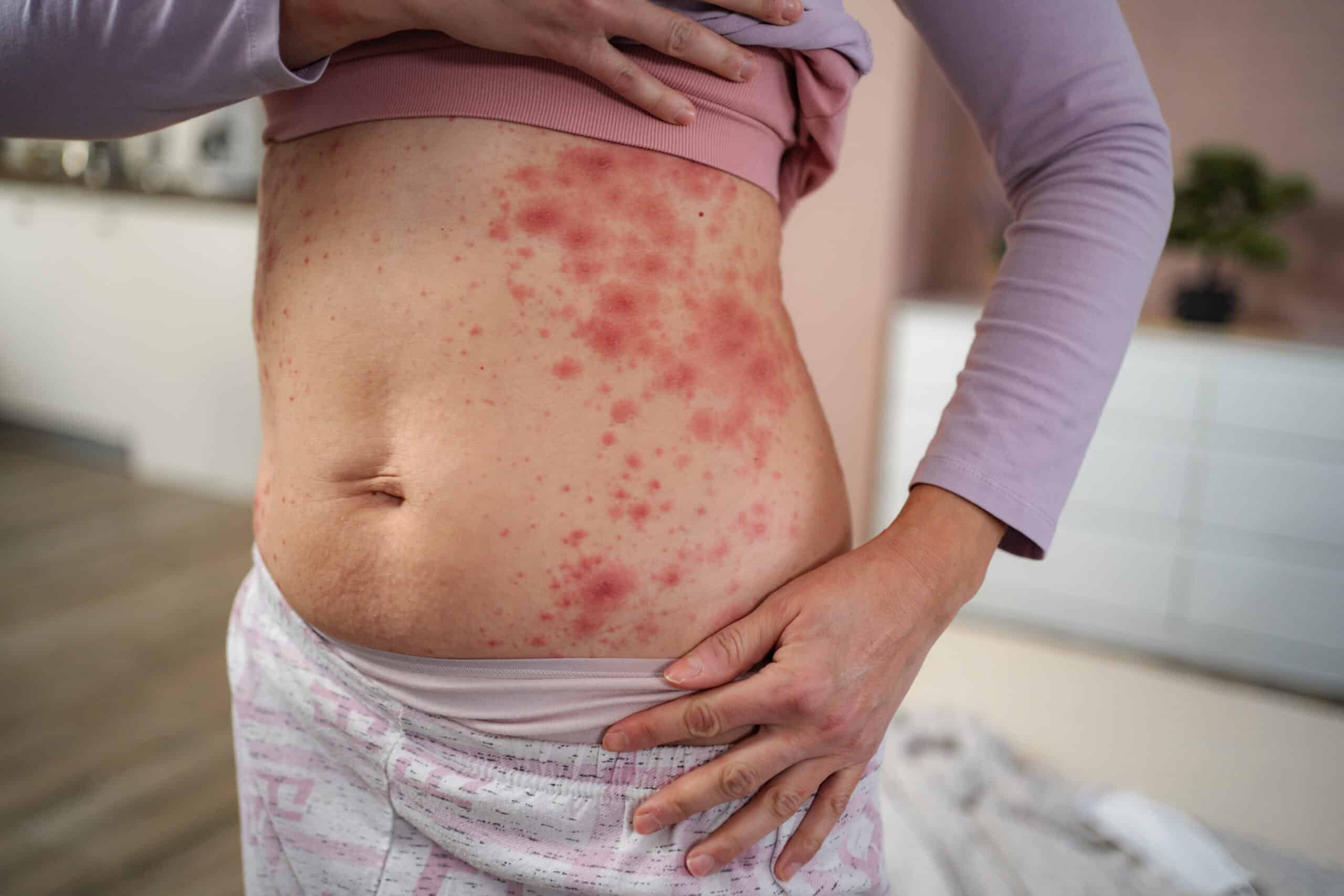 Understanding Rashes and When They Need Medical Care
