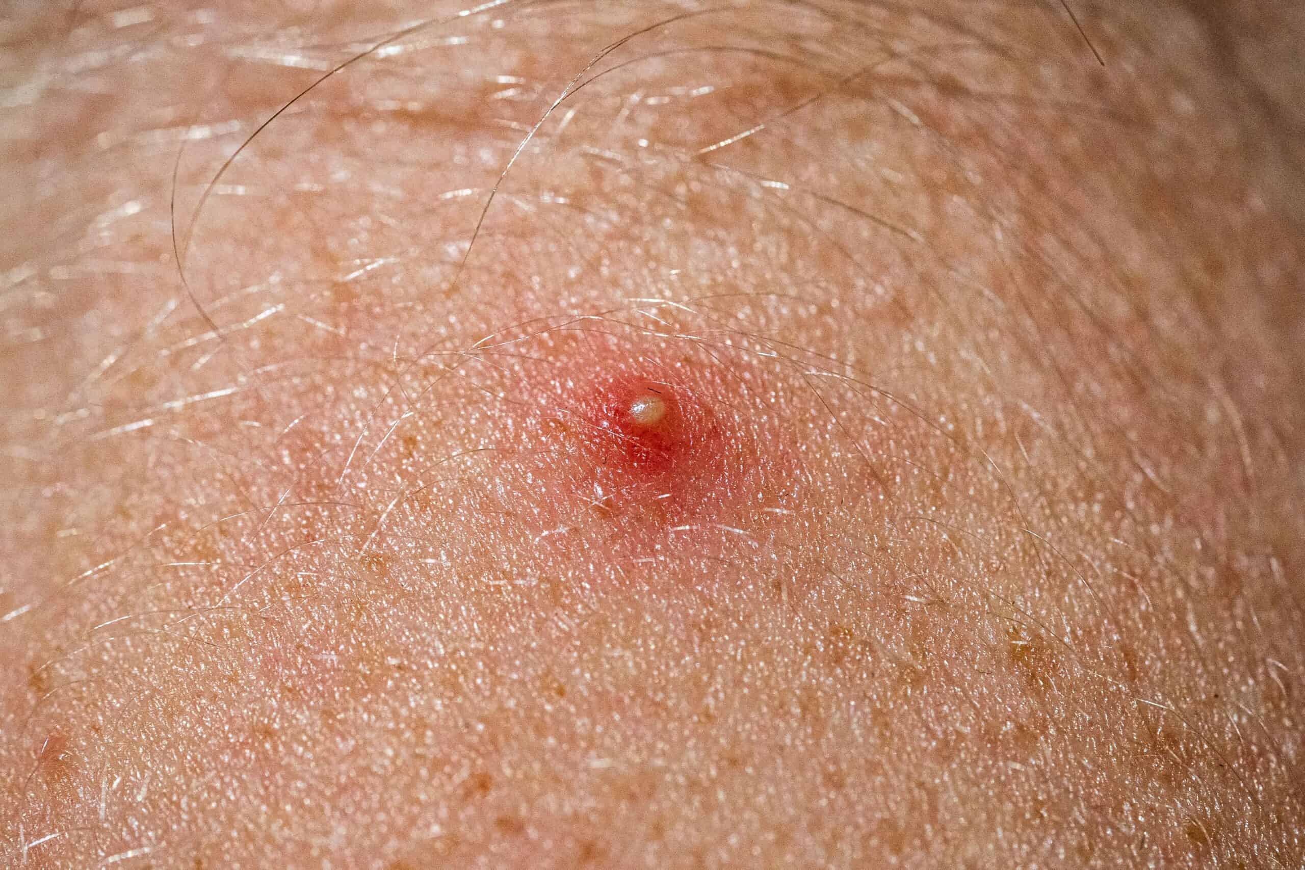 When a Painful Bump Could Be More Than a Pimple